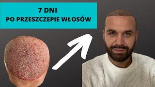 Przeszczep włosów w Turcji - RELACJA, ZDJĘCIA - 7 dni po zabiegu.