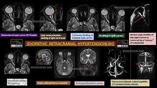 IDIOPATHIC INTRACRANIAL HYPERTENSION -CASE OF THE MONTH