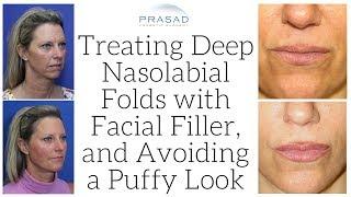 How Deep Nasolabial Folds can be Treated with Long Lasting Cosmetic Filler, without Looking Puffy