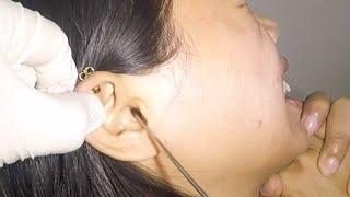 Removing Something Stuck in Woman's Ear for Days