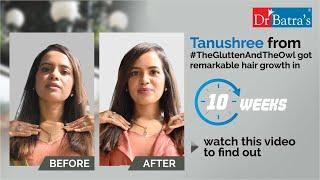 Dr Batra Hair Loss Treatment Reviews | Know how Tanushree had an amazing hair growth in 10 weeks!