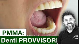 Denti provvisori PREMIUM in PMMA - Denti per All On 4 o All On 6 provvisorie