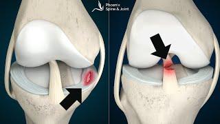 Is your knee pain coming from an ACL tear or Meniscus injury? How to tell.