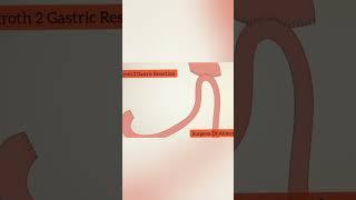 Bilroth 2 Gastric Resection Animation #viral #health #surgerysimplified