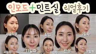 인모드 + 민트실 리프팅 찐 리얼후기‼️ 기간별 경과유지가격통증부작용효과‼️