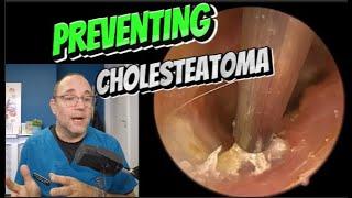 PREVENTING CHOLESTEATOMA! 386 #ear #earwax #earwaxremoval  #satisfying #foryou #fyp #foryourpage