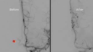 Commentary on a #cubitalfirst transvenous embolization of an ethmoidal dAVF