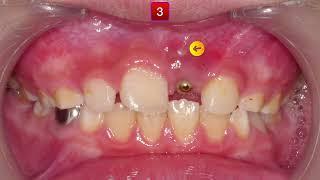 U1 Impaction Treatment｜【Chris Chang Ortho】CC813