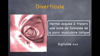 Diverticulose Colique et Sigmoïdite  - 1. Diverticule, diverticulose, diverticulite non compliquée