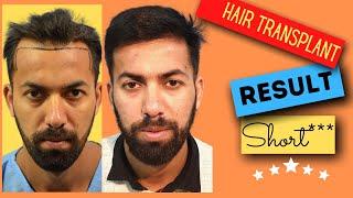 Hair transplant result 2021 | Darling Buds Clinic  in India