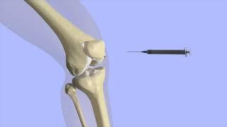 Knee Joint Injection