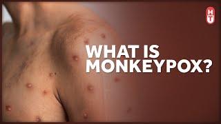 Monkeypox: What is It and Who is at Risk?