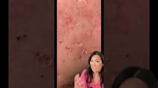 #duet on TT with @mypimplepop - check out my SLMD Skincare body acne products
