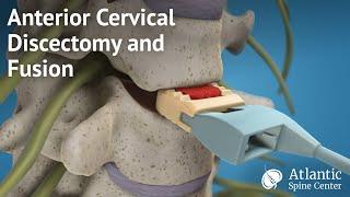 Anterior Cervical Discectomy and Fusion