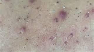 Back Treatment - Blackhead extractions