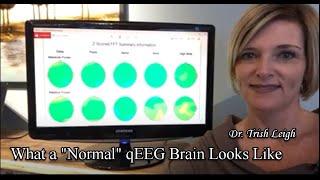 What a "Normal" qEEG Brain Map looks like.