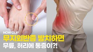 무지외반증 방치하면 무릎, 허리에 통증이?!