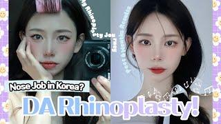 [Plastic Surgery Korea] Rhinoplasty Post 3 Months Follow-Up!! Come Join My Journey 