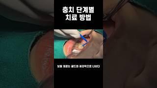 충치 단계별 치료 방법 4단계