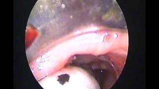 Pharyngo oesphageal stenosis3