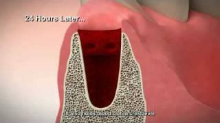 Tooth Extraction and Socket Preservation