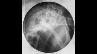 Radiographic Positioning of the Thoracic Spine