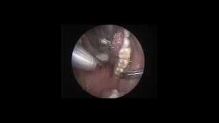 Laser assisted Uvulo Pharyngo Palato Plasty