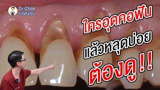 ใครอุดคอฟัน แล้วหลุดบ่อยๆ ต้องดู ?!! | คลายปัญหารากฟันเทียมกับหมอโชค