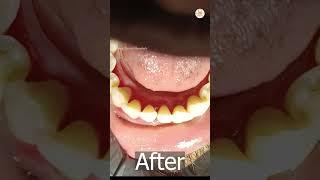 Tooth Cleaning Close-Up View | Eledent Dental Hospitals | Best Dental Hospital In Hyderabad