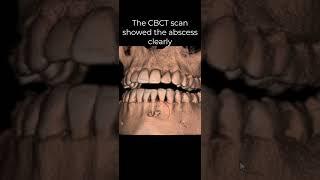 Here's how the ImageWorks cone beam was critical to identifying an abscess on #24