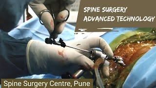 Prolapsed disc. Is Endoscopic Discectomy correct for me? Advanced Technology in spine surgery.