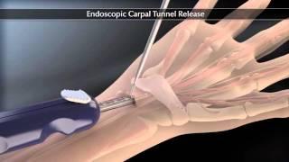 Endoscopic Carpal Tunnel Release