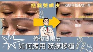 雙眼皮疤超深？肉條感？重修雙眼皮需要筋膜移植嗎？—沈筠惇醫師 Dr. Michael 眼整形