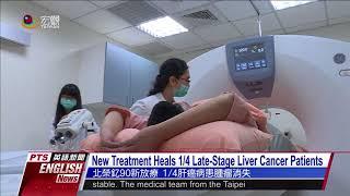 北榮釔90新放療 14肝癌病患腫瘤消失 New Treatment Heals 14 Late Stage Liver Cancer Patients—英語新聞