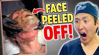 Peeling Off Faces with TOXIC Phenol! Plastic Surgeon Reacts!