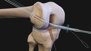 Arthrex ACL Reconstruction