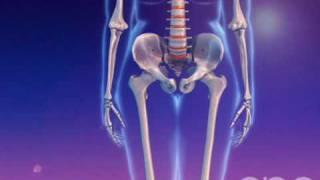 Osteoporosis - 3D Medical Animation || ABP ©