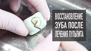 Лечение пульпита – часть 2 | пломбирование зубов  | стоматология Cамара