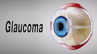 Glaucoma (Animation of Why It Happens and How It Can Cause Blindness)