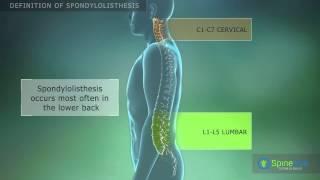 Spondylolisthesis Definition