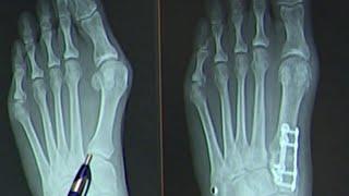 Healthcast: New bunion surgery cuts recovery time