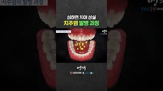 잇몸뼈 녹아내리는 치주염 발병과정