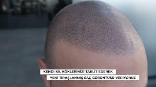 KIL KÖKÜ GÖRÜNÜMÜ TEKNİĞİ NEDİR?