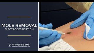 Electrodessication to Remove Seborrheic Keratosis