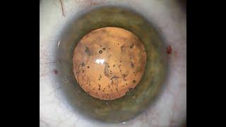 Cataract Surgery as an IOP Lowering Procedure (Malik Y. Kahook, MD)