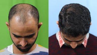 Best Hair Transplant Result 2021 || NW Grade VI || 4,479 Grafts || Regrow Clinic Haridwar