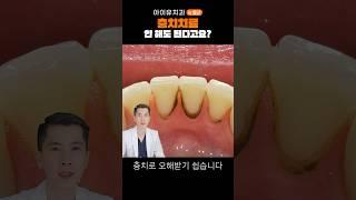 치료 안 해도 되는 충치 #shrots