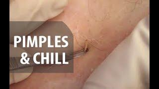 Pimples & Chill | Dr. Derm