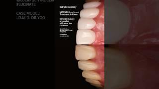 Esthetic Dentistry Laminate (Dental Veneers) Treatment in Korea #dentist #dentistry #laminate #라미네이트