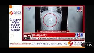 Another Life Saved! Sairam Hospitals Successfully Remove (Renigaya) Without Surgery 